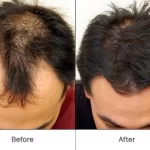 Hair Regrowth treatment cost in india