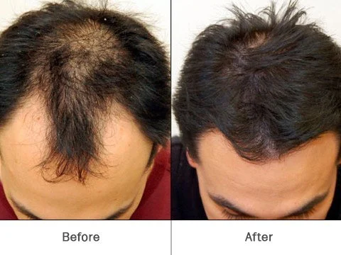 Hair Regrowth treatment cost in india