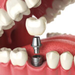 What Are Dental Crowns