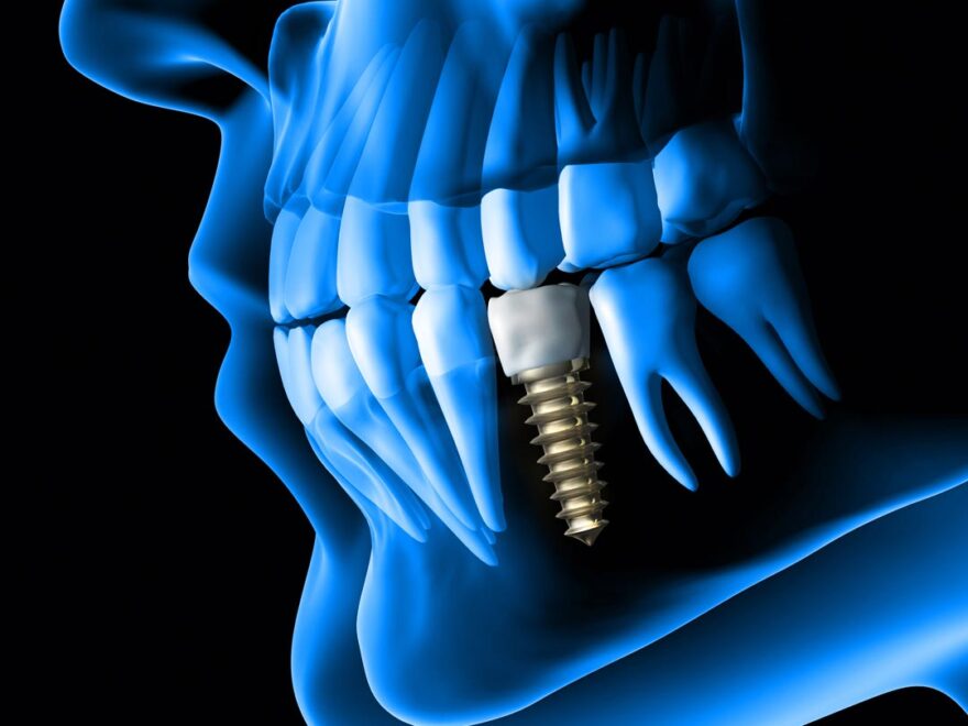 Best Dental Implants in Dubai