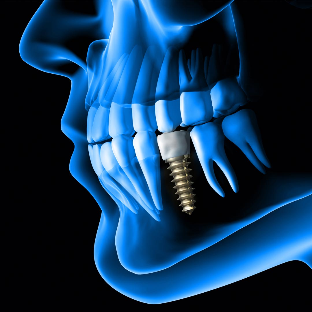 Best Dental Implants in Dubai