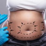 Navigating the Road to Recovery What to Expect After Abdominoplasty in Dubai