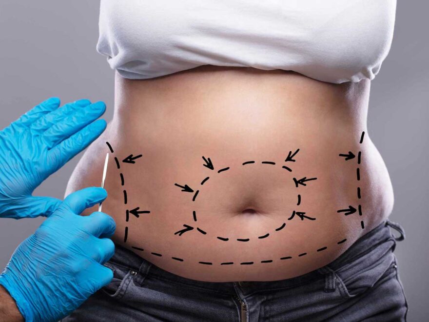 Navigating the Road to Recovery What to Expect After Abdominoplasty in Dubai