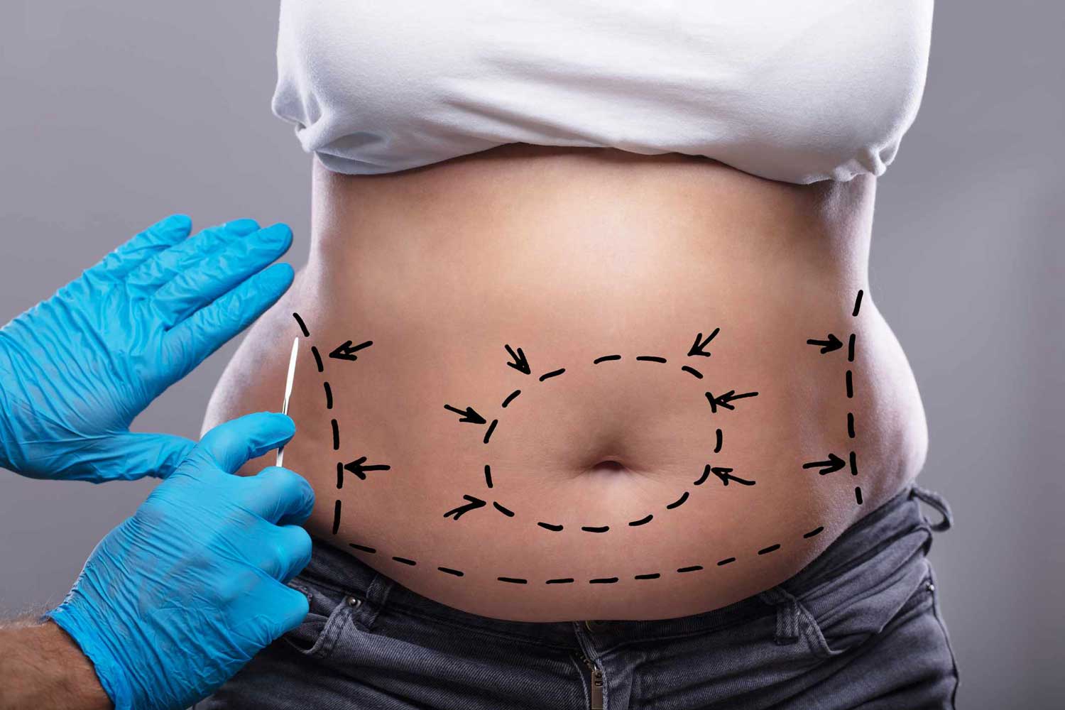 Navigating the Road to Recovery What to Expect After Abdominoplasty in Dubai