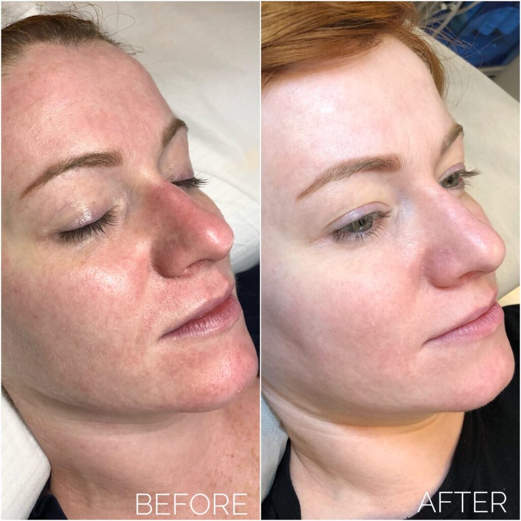 Real Experiences: BB Glow Treatment Before and After Stories