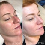 Real Experiences: BB Glow Treatment Before and After Stories