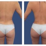 Are Brazilian Butt Lift Scars Worth The Advantages Of The Surgery?