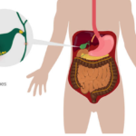 Gall bladder stone treatment without surgery in Ayurveda