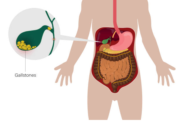 Gall bladder stone treatment without surgery in Ayurveda