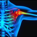 Decoding the Complexities of Shoulder Pain: A Comprehensive Guide by Dr. Sana Sayyad’s