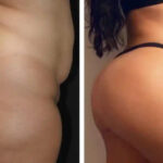 Planning Your Liposuction Journey in Dubai: A Step-by-Step Guide