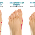 Minimally Invasive Bunion Correction