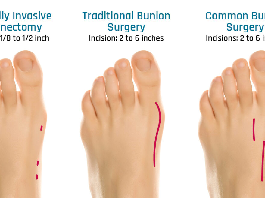 Minimally Invasive Bunion Correction