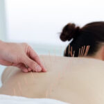 Acupuncture therapist