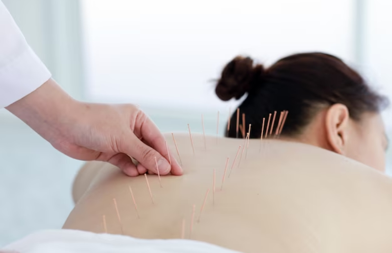 Acupuncture therapist