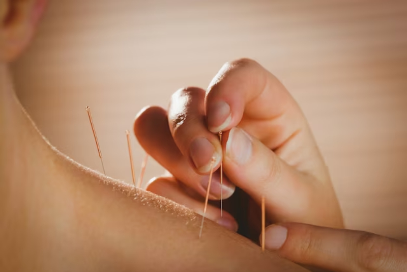 Acupuncture therapist