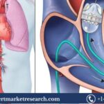 Transcatheter Pulmonary Valve Market