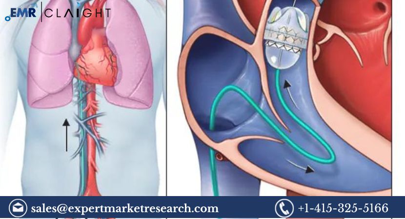 Transcatheter Pulmonary Valve Market