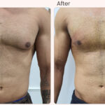 Gynecomastia Mastery: What you need to know