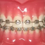 dental braces singapore