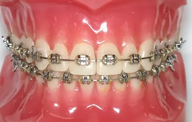 dental braces singapore