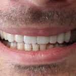 Are Dental Implants In Citycentre The Ultimate Solution For West Houston’s Smile Woes?