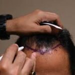 Revitalize Your Confidence: The Ultimate Guide to Hair Transplants in Bangalore