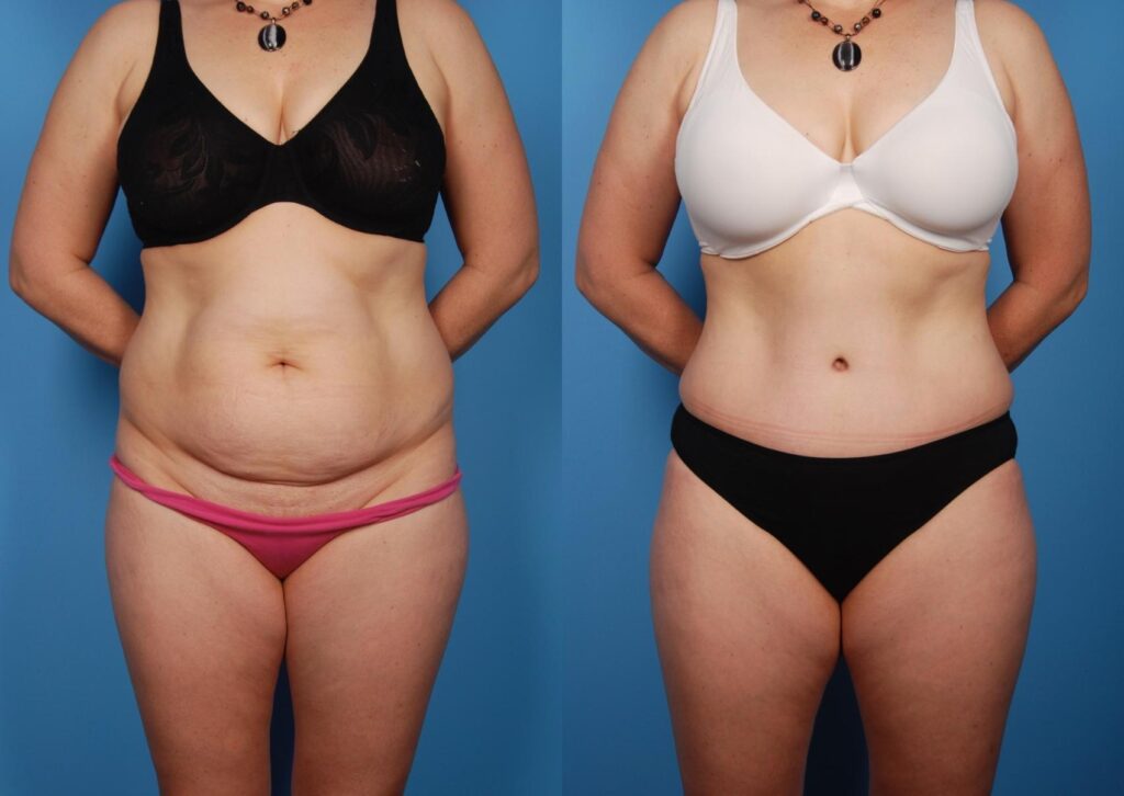 Will a Tummy Tuck Make You Look Thinner? A complete Guide