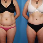 Will a Tummy Tuck Make You Look Thinner? A complete Guide