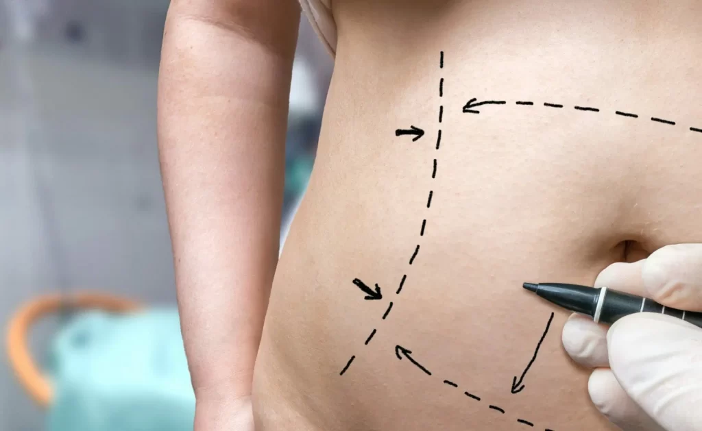 Unveiling the Cost Spectrum: Exploring Tummy Tuck Prices in the UAE