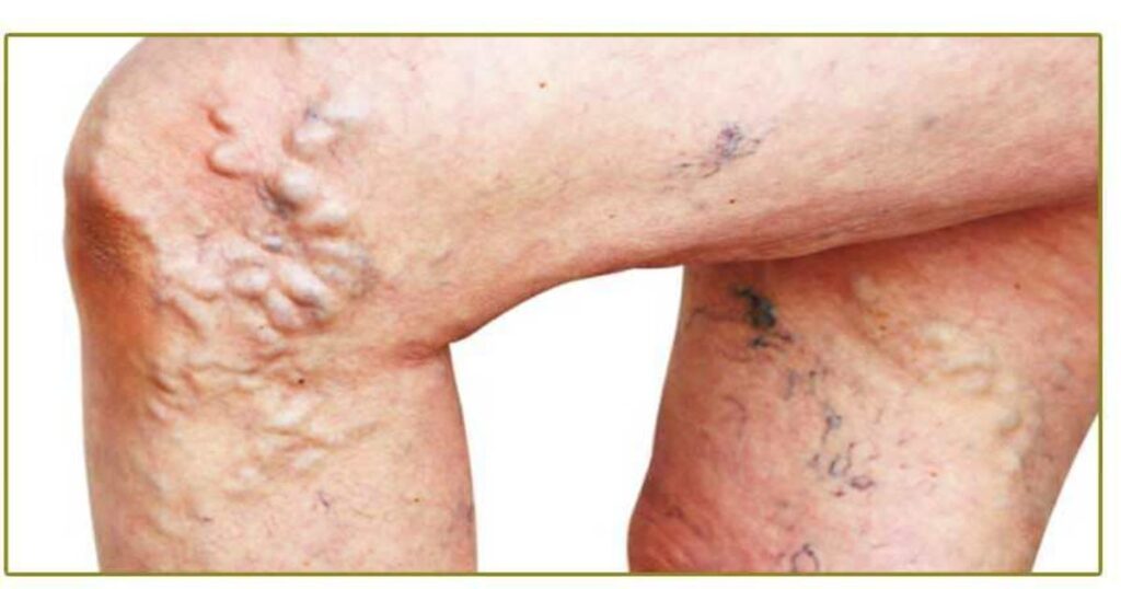 what type of doctor treats varicose veins