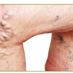 what type of doctor treats varicose veins