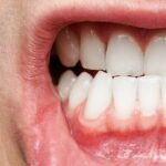 How To Cure Gum Disease Without a Dentist?