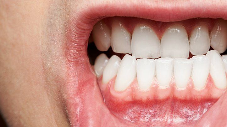 How To Cure Gum Disease Without a Dentist?