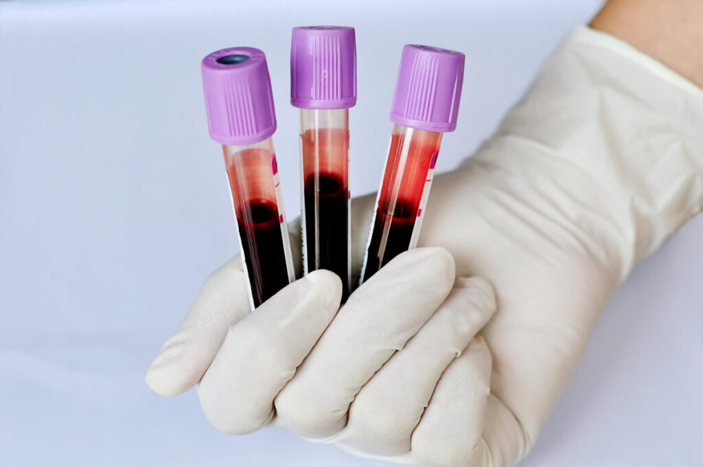 Blood Analysis Melbourne