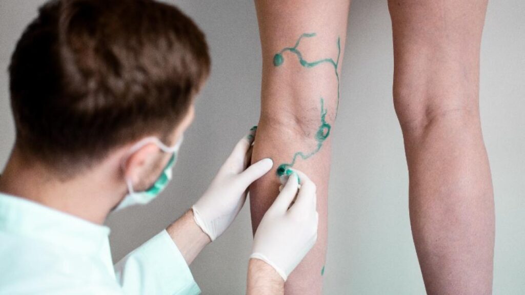 Advancing Varicose Vein Treatments: What Is The Latest Breakthrough In Medical Solutions?