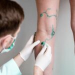 Advancing Varicose Vein Treatments: What Is The Latest Breakthrough In Medical Solutions?