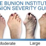 Bunion Treatment