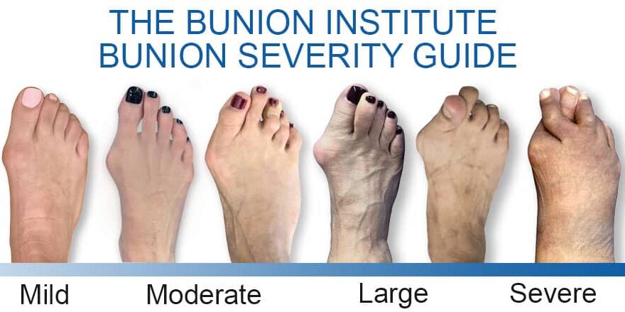 Bunion Treatment