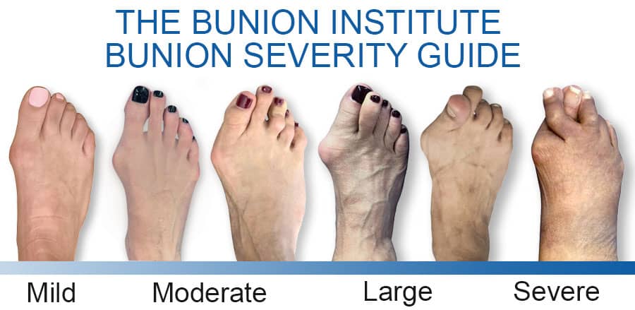 Bunion Treatment