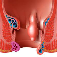 Rectal Polyp Excision