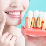 Advantages Of Dental Implants In Singapore: Are Singapore Braces The Ideal Solution?