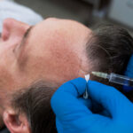 What is Hair Implantation? Does it have any Side Effects?