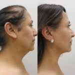 What Are The Advantages Of Neck Liposuction And BBL Surgery?