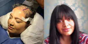 5000 grafts hair transplant