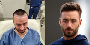 4000 grafts hair transplant