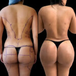 Enhancing Your Curves: The Rise of Buttock Fat Transfer in Dubai