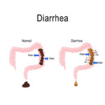 Diarrhea