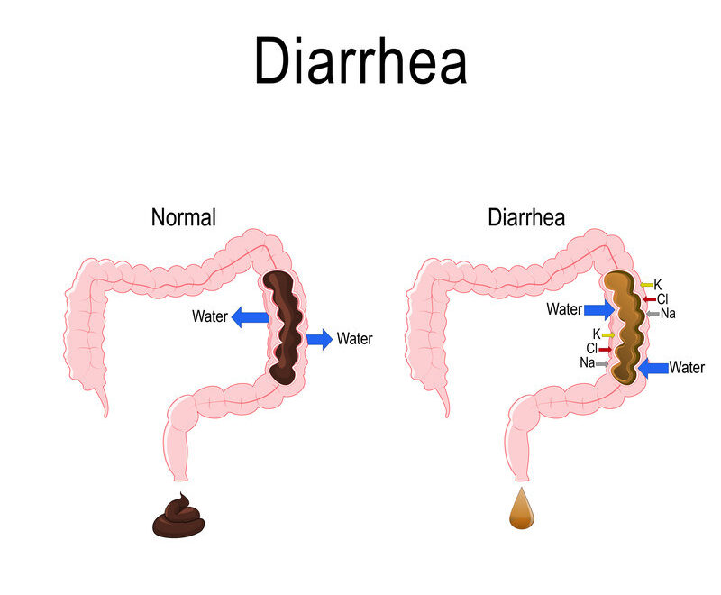 Diarrhea