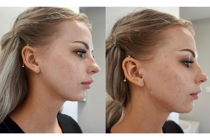 Jawline Filler